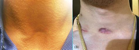 Posttracheostomy Scar Of Person Who Underwent Pdt A With Less