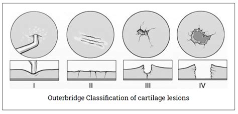 Articular Cartilage Injuries And Management Home Consultant