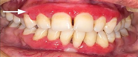 Plasma Cell Gingivitis A Perplexing And Rare Clinical Entit