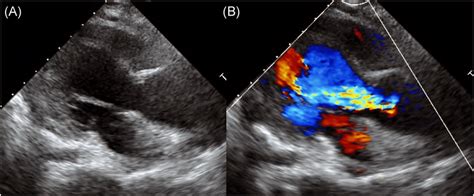 Preoperative Echocardiogram Shows A Aortic Dilatation And B