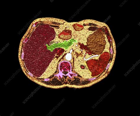 Pancreatic Carcinoma Ct Scan Stock Image C050 9723 Science Photo Library