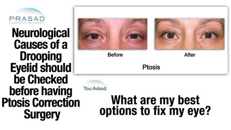 Checking Cause of Drooping Eyelid is Important before Deciding on ...