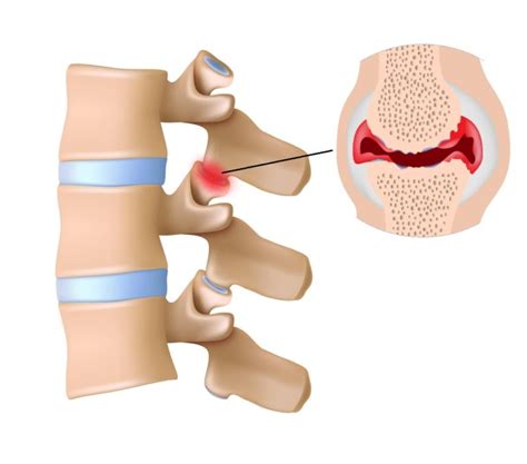 Facet Hypertrophy Symptoms, Diagnosis, Treatment | AllSpine