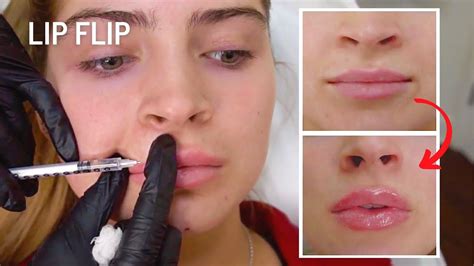 Lip Flip Botox Before And After Photos - Infoupdate.org