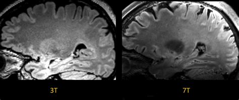Neuroimaging At 3t Vs 7t Magnetic Resonance Imaging Clinics