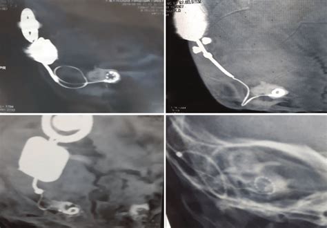 Postoperative Imaging A Modified Stenvers View Of The Right Temporal