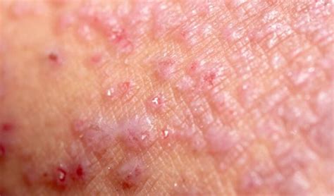 Dermatitis Qu Es Tipos Causas Y Tratamiento Farmacia Martel En Madrid