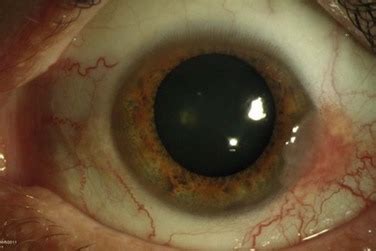 Ocular Surface Neoplasias Ento Key