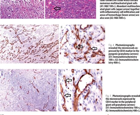 Table 2 From Comparison Between Gingival Pyogenic Granuloma And