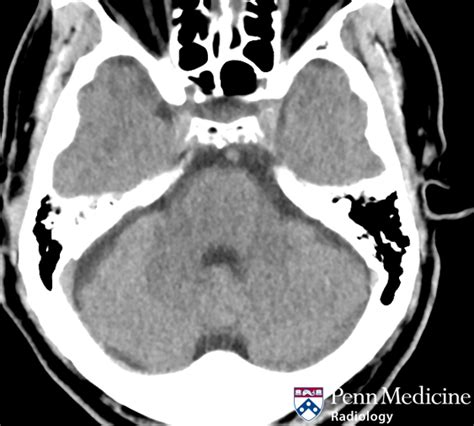 Year Old Man With Sudden Onset Left Sided Weakness Auntminnie