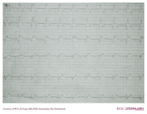 Atrial fibrillation with LBBB EKG examples - wikidoc