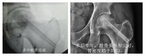 股骨头坏死微创治疗——髓芯减压、打压植骨术！ 健康界