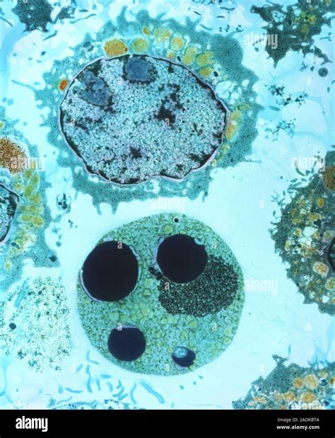 Apoptosis Coloured Transmission Electron Micro Graph TEM Of A