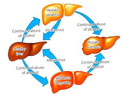 Drinking and Chronic Liver Disease: What You Need to Know