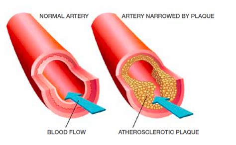 Blocked and Narrowed Arteries: What This Means for Your Heart Health