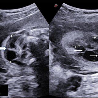 Ultrasound At 20 Weeks Of Pregnancy Showing Septal Cervical Cystic