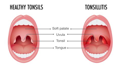 Tonsillitis | Getcured Apothecary Pvt Ltd