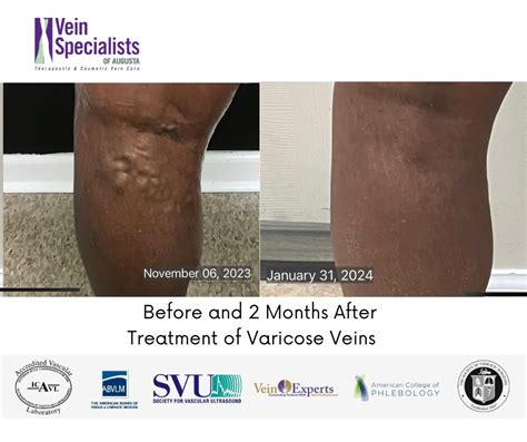 Before After Vein Treatment At Vein Specialists Of Augusta