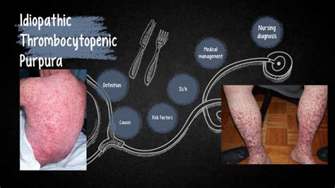 Idiopathic Thrombocytopenia Purpura By Nat Lynne On Prezi