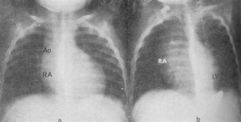 Tricuspid atresia chest x ray - wikidoc