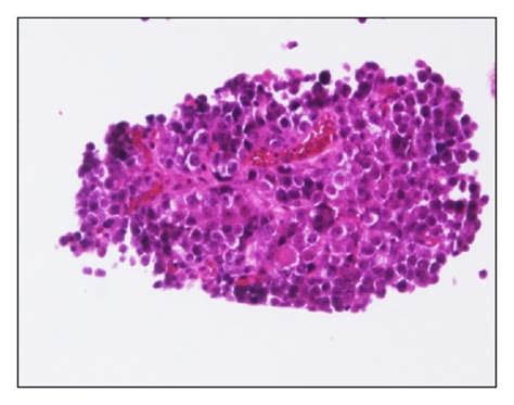 Vascular Vessel Mediated Metastasis A In Vascular Vessel Mediated