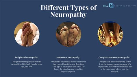 Ppt Neuropathy Causes Symptoms And Treatments Hill Regional Hospital