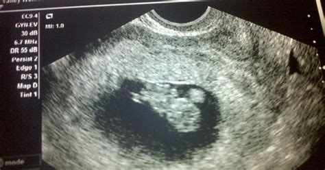 Lone Sunflower: 9 Week Baby Ultrasound