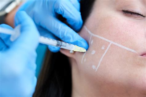 Botox For Bruxism Understanding The Benefits And Procedure