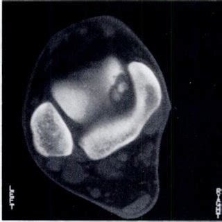 Figure 2-The fine structure of the cancellous bone and the cortex of ...