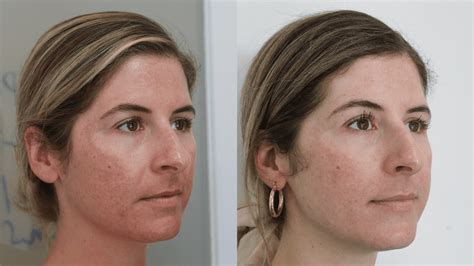 Cosmelan Peel Before And Afters View Real Patient Results