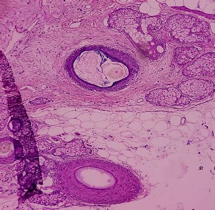 Mature Cystic Teratoma Ovarian Cyst Biopsy Show Cyst Wall Of Skin And ...