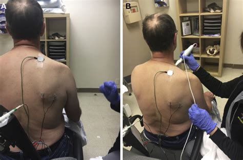 Subscapularis Integrity Function And EMG Nerve Conduction Study