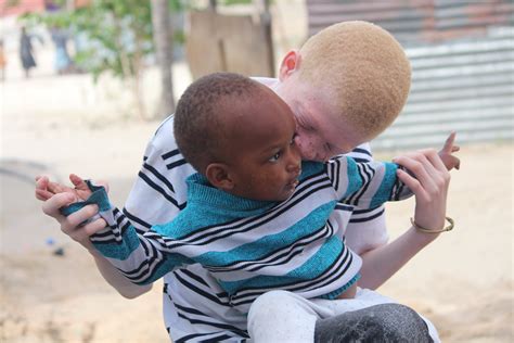 Individuals With Albinism Face Human Rights Violations Globally Daily