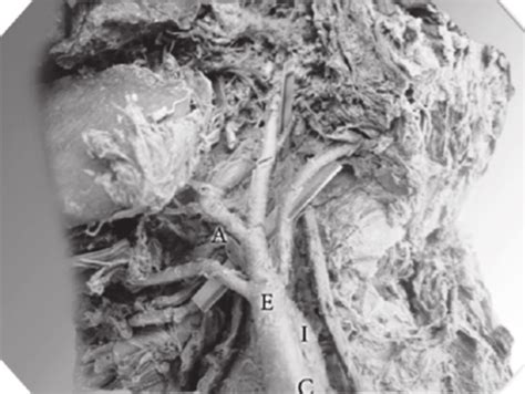 The Level Of The Bifurcation Of The Right Common Carotid Artery C At