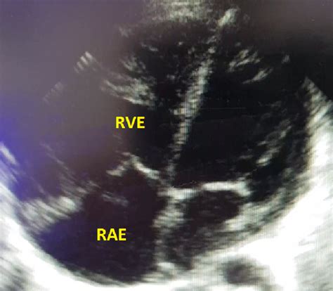 Apical Four Chamber View Of Transthoracic Echo Showing Right Heart