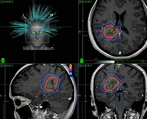 Radiation Dose To The Fetus During Cyberknife Radiosurgery For A Brain