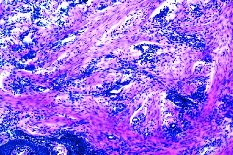 The newly formed connective tissue of the reticular layer. Stained with ...