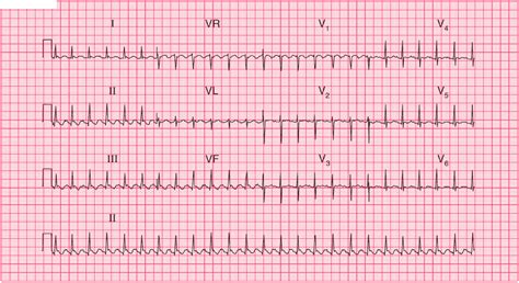 Hypokalemia ECG Changes With Examples Manual Of Medicine