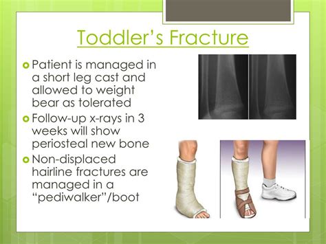 Ppt Introduction To Pediatric Orthopaedics Common Fractures