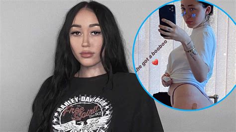 Noah Cyrus Shows Off Swollen Butt Cheeks After Being Bitten By A Spider