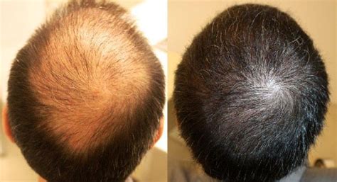 Before After Hair Hair Transplant Hair Restoration Green Hair Botox