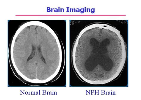 Something interesting about Normal Pressure Hydrocephalus Treatment