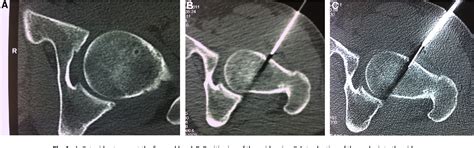 Figure From Percutaneous Ct Guided Radiofrequency Thermocoagulation