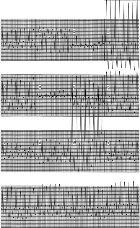 Electrocardiogram Ventricular Tachycardia Download Scientific Diagram