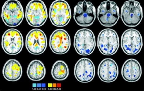 Bipolar Disorder Diagnosis May Soon Include Mri Brain Scan Test