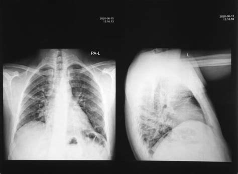 Anteroposterior Longitudinal Chest X Ray Cxr Ap L Imaging Performed