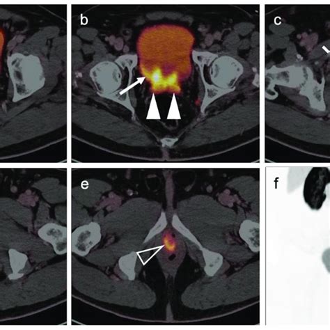 PSMA RADS Structured Reporting System For PSMA Targeted PET CT For