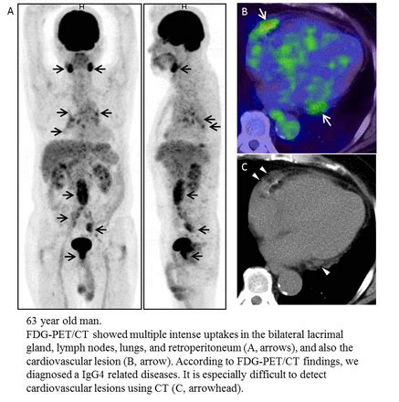 Igg Related Diseases Whole Body Fdg Pet Ct May Be Easier To Evaluate