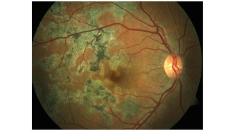 Ocular Tuberculosis Article