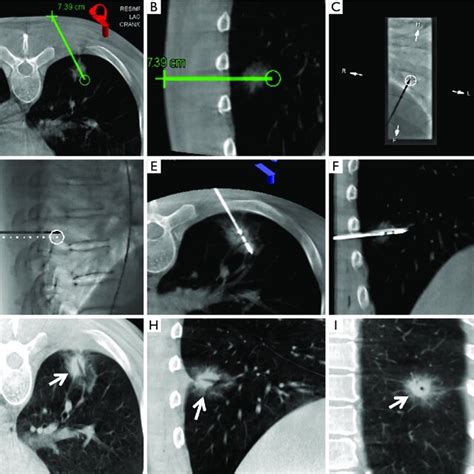 The Process Of C Arm Ct Guided Mwa For Nsclc The Puncture Path Green